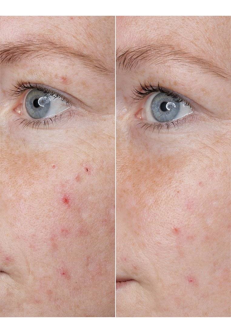 BABOR BABOR HYALURONIC ACID AMPOULE - Serum Begrenztes Angebot